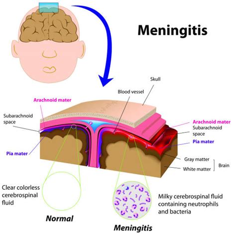 can acute sinusitis lead to meningitis